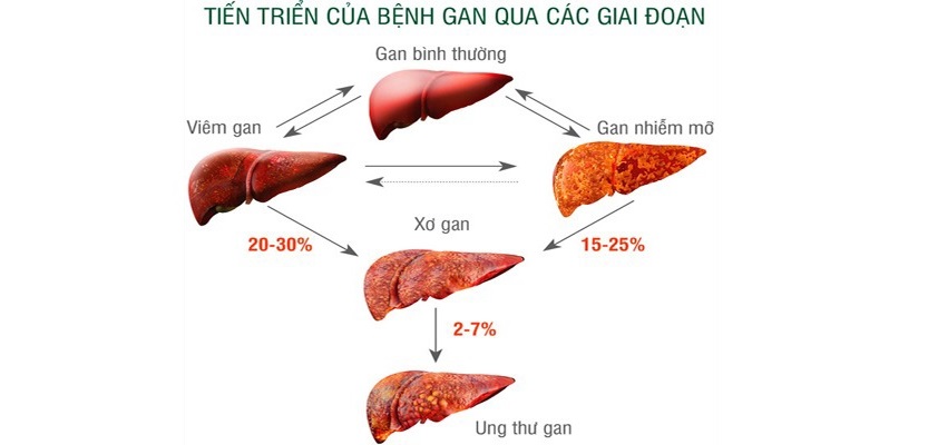 qua-trinh-dan-den-ung-thu-gan