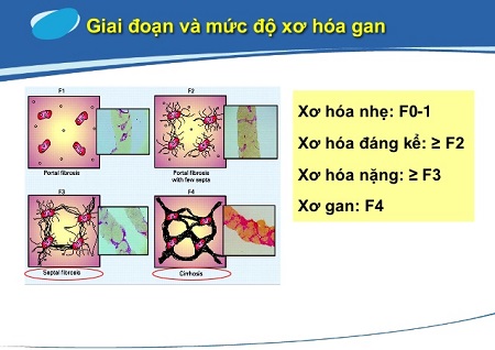 dieu-tri-xo-gan-1