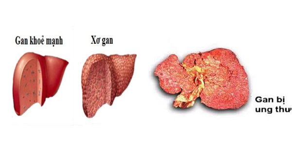 xo-gan-ung-thu-gan